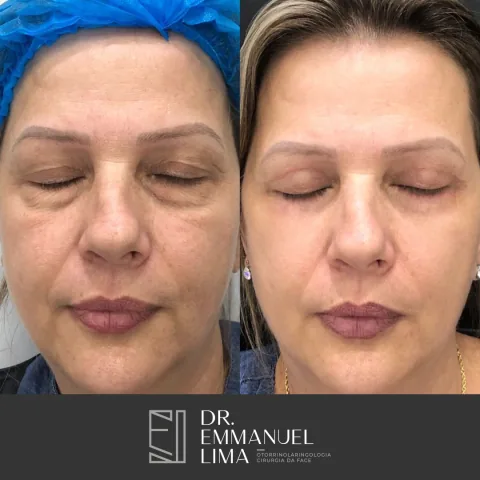 Antes e depois de blefaroplastia completa, caso 2