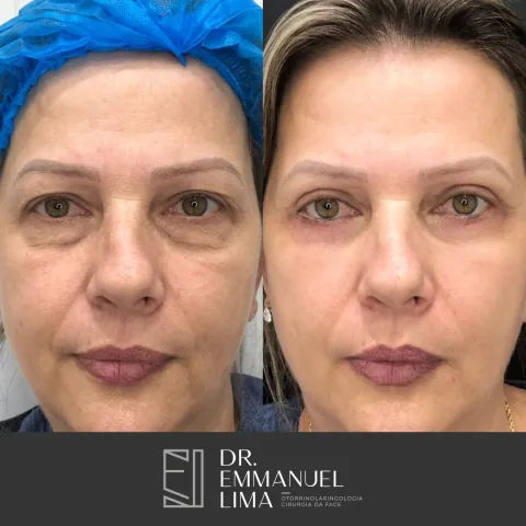 Antes e depois de blefaroplastia completa, caso 3