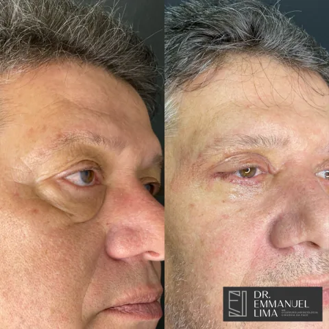 Antes e depois de blefaroplastia completa, caso 4