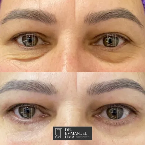 Blefaroplastia Inferior