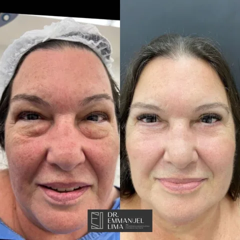 Antes e depois de blefaroplastia inferior, caso 2