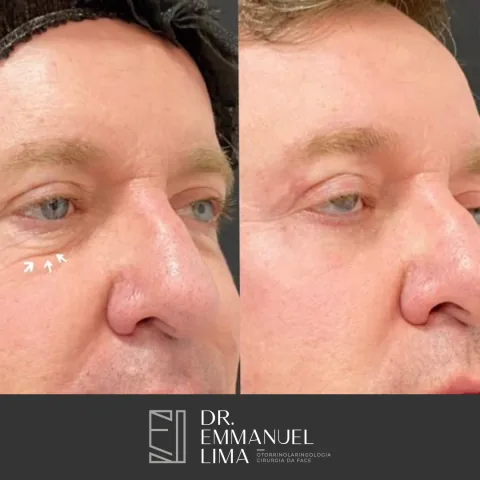 Antes e depois de blefaroplastia inferior, caso 3