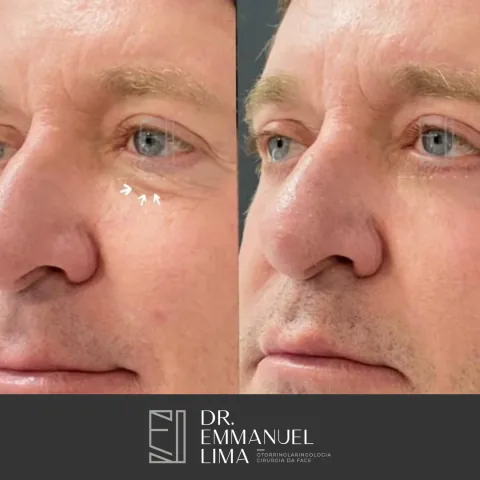 Antes e depois de blefaroplastia inferior, caso 4