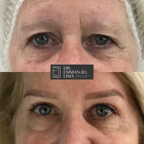 Antes e depois de blefaroplastia superior, caso 2