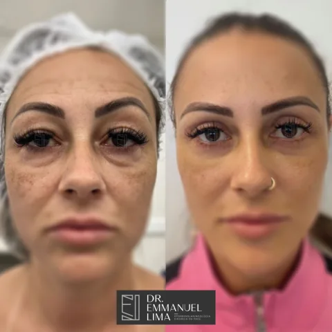 Antes e depois de blefaroplastia superior, caso 3