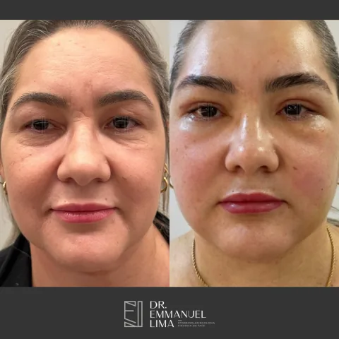 Antes e depois de lifting facial, caso 2