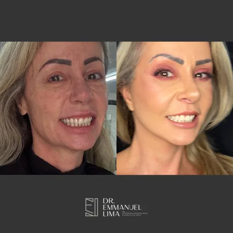Antes e depois de lifting facial, caso 3
