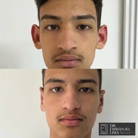 Antes e depois de otoplastia, caso 2