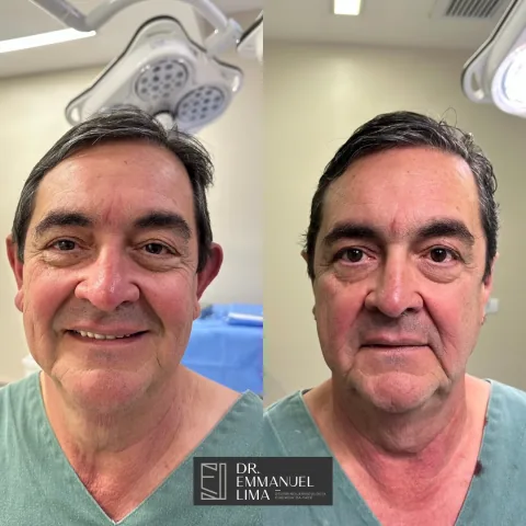 Antes e depois de otoplastia, caso 3