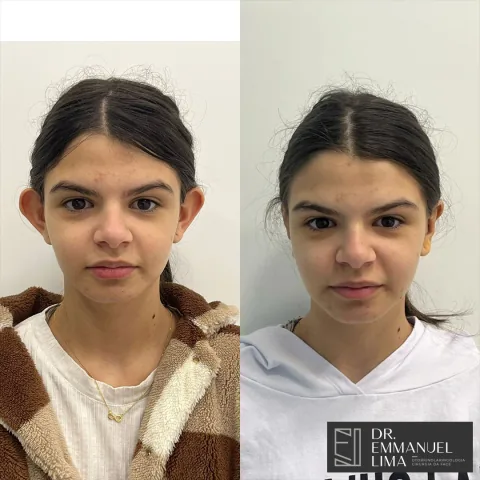 Antes e depois de otoplastia, caso 4