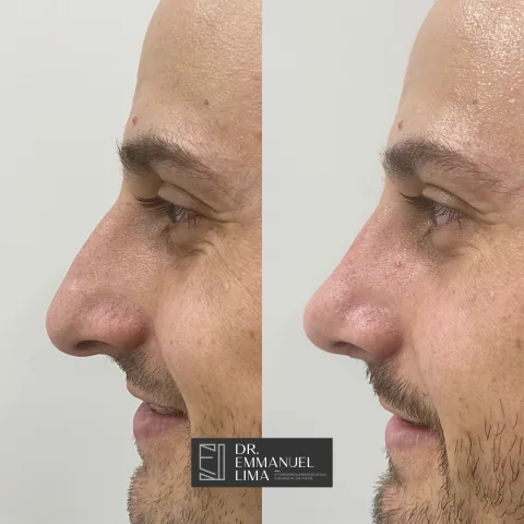 Rinoplastia