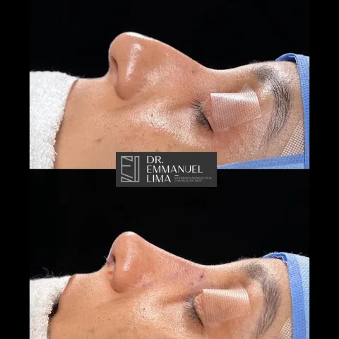Antes e depois de rinoplastia, caso 2