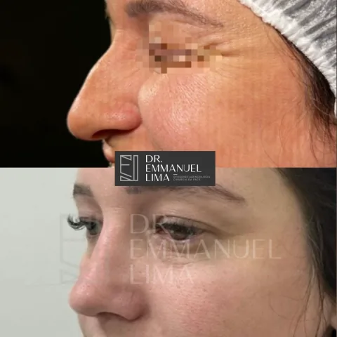 Antes e depois de rinoplastia, caso 3