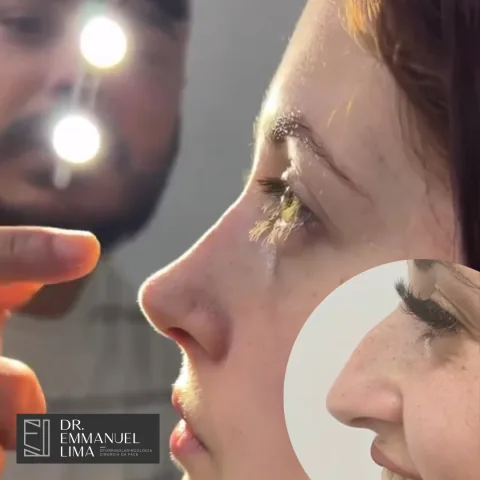 Antes e depois de rinoplastia, caso 4